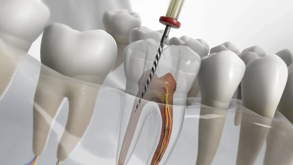 Root Canal in Lahore: What to Expect (And Why It’s Not Scary)