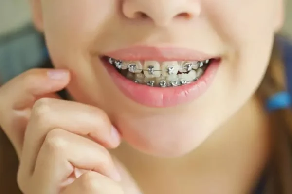 Braces and Orthodontics