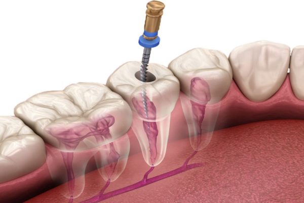 Root Canal Treatment