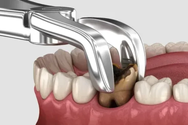 Tooth Extractions