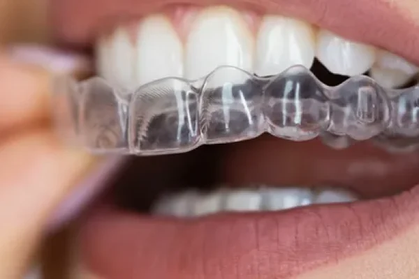 Clear Aligners