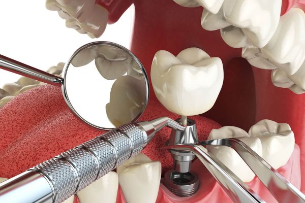 Dental Implants